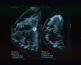 dense breast ultrasound