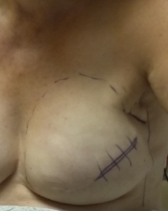 surgeon marks