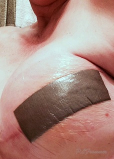 implant swelling
