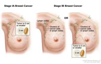 cancer stages